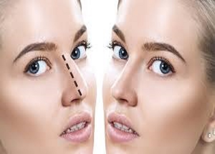 Rhinoplasty in Dubai