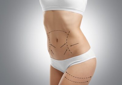 Liposuction-in-Riyadh-3