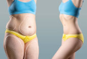Liposuction in Riyadh