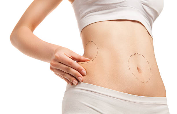 Liposuction in Riyadh